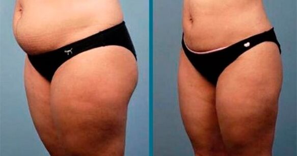 Metodai, kaip numesti svorio 10 kilogramų per mėnesį